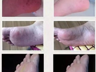 脚上如何分辨是湿疹还是脚气（脚上怎么分辨是湿疹还是过敏）